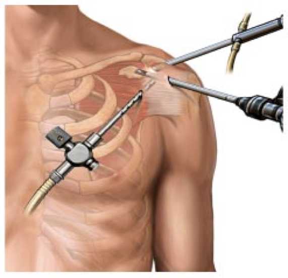 shoulder arthroscopy tunisia price cheap rate