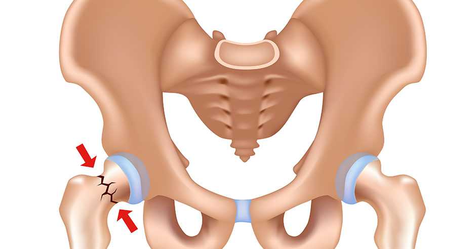 femoral neck fracture tunisia price affordable