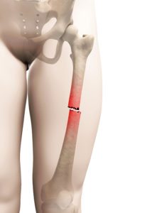 femur fracture tunisia price affordable