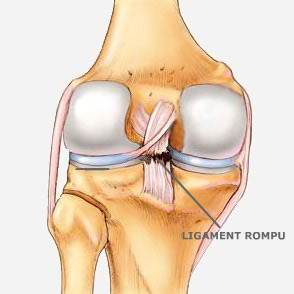 What is ACL rupture
