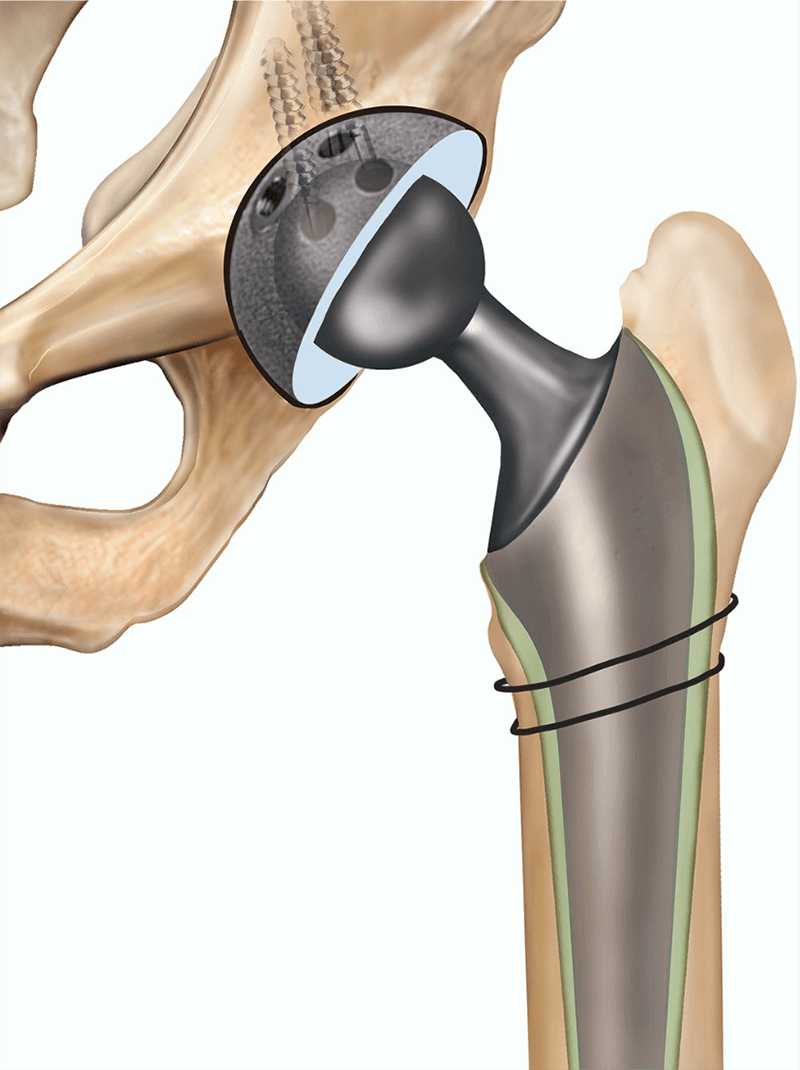 total hip replacement THR tunisia price cheap cost